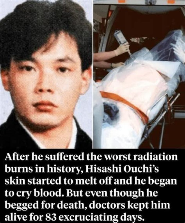 Who Was Hisashi Ouchi? Radiation Burn Body Images On Reddit, Before And After!